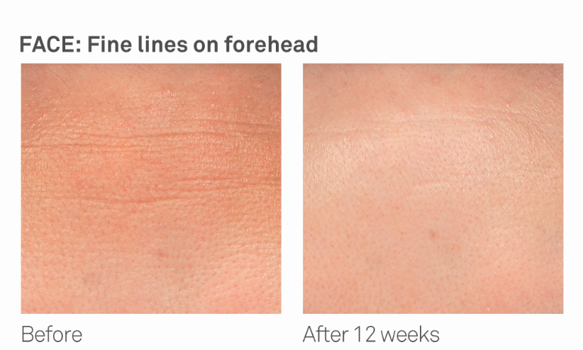 Improvement of fine lines on forehead