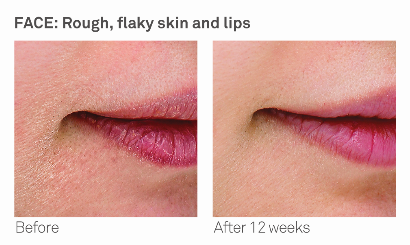 Improvement on flaky skin and lips