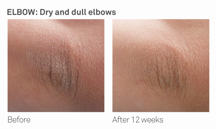 Improvement on dry and dull elbows