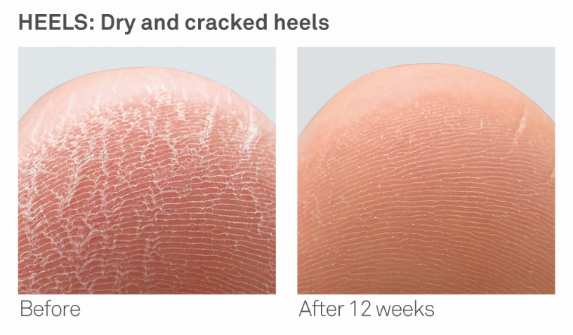 Improvement on cracked heels