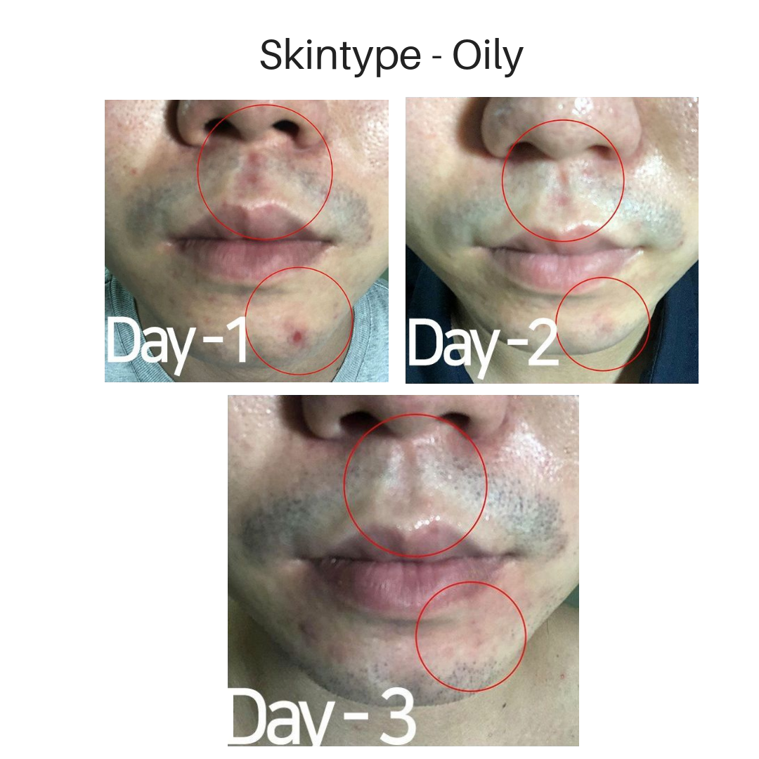 before and after photos of using Troiareuke spot treatment on acne-prone and sensitive skin