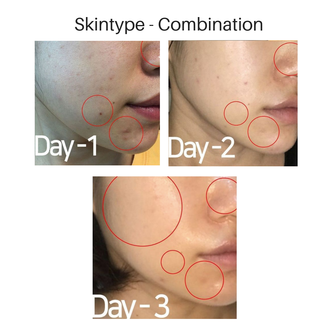 before and after photos of using Troiareuke spot treatment on acne-prone and sensitive skin