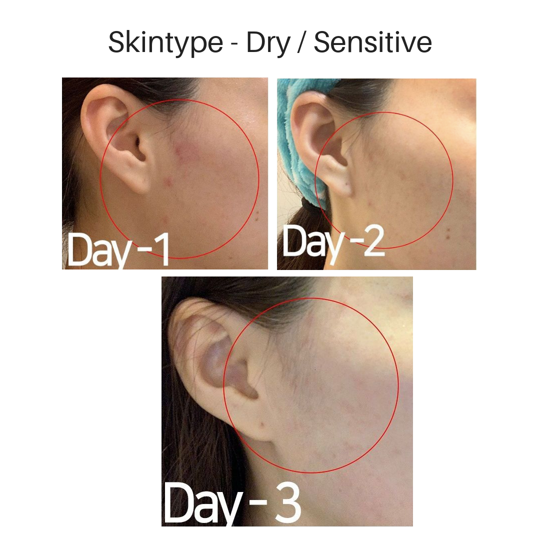 before and after photos of using Troiareuke spot treatment on acne-prone and sensitive skin