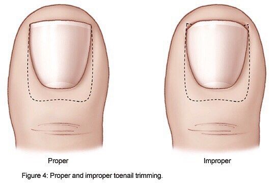Right and wrong way of cutting toenails