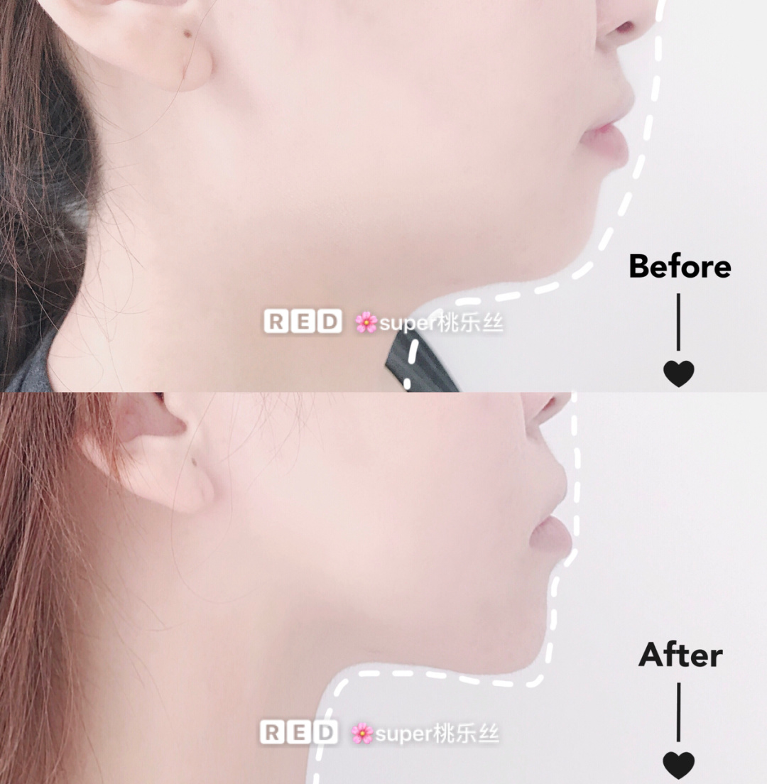 facial exercise to get rid of double chin