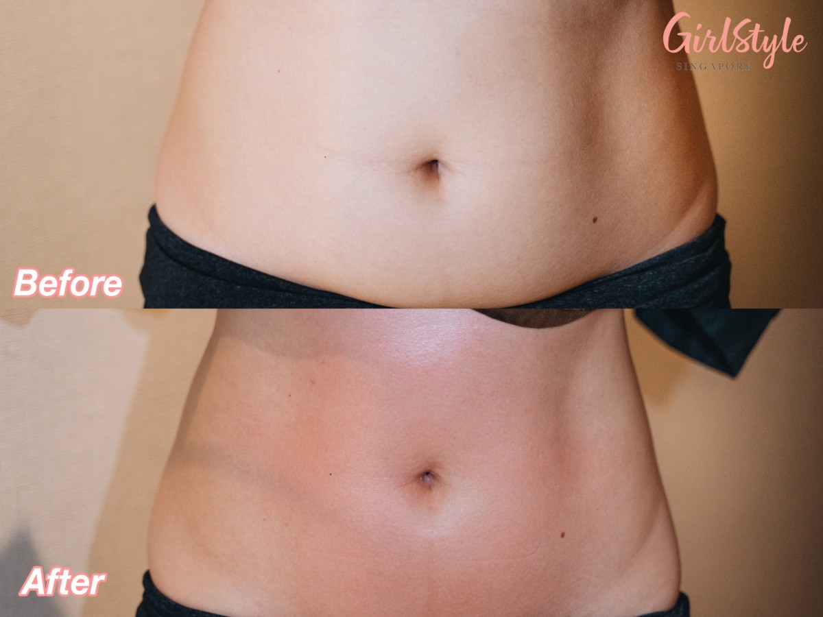 Before and after image of model's tummy