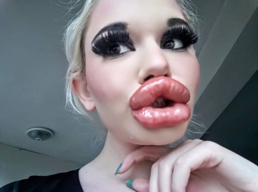 World's Biggest lips: Woman Goes Viral After Getting 20 Lip Injections