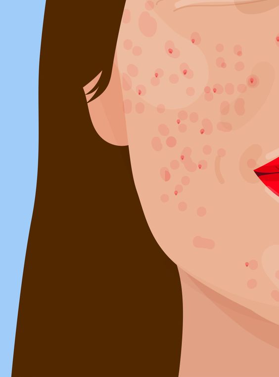 Graphics of lady with pimples