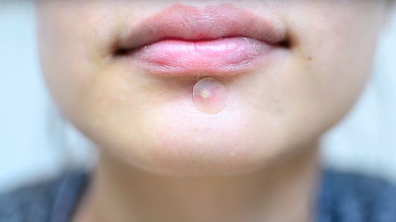 Using pimple patch on pimple