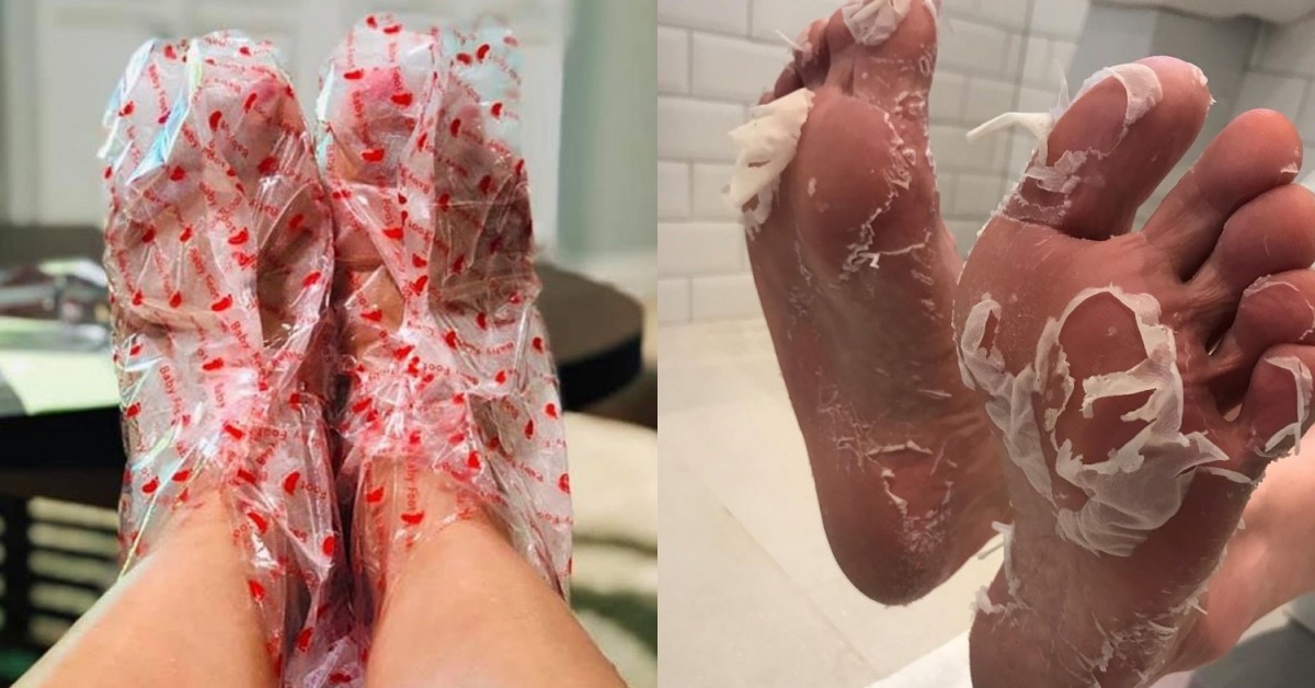 Baby Foot peel mask Singapore