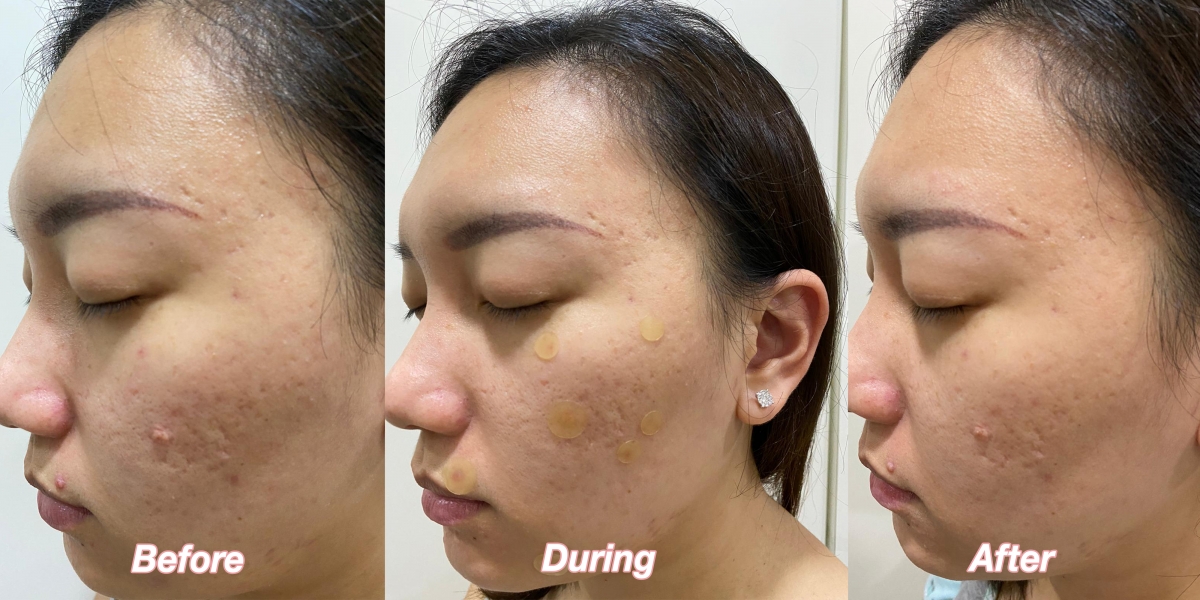 Eunice's before and after using Nexcare Tea Tree Acne Patch