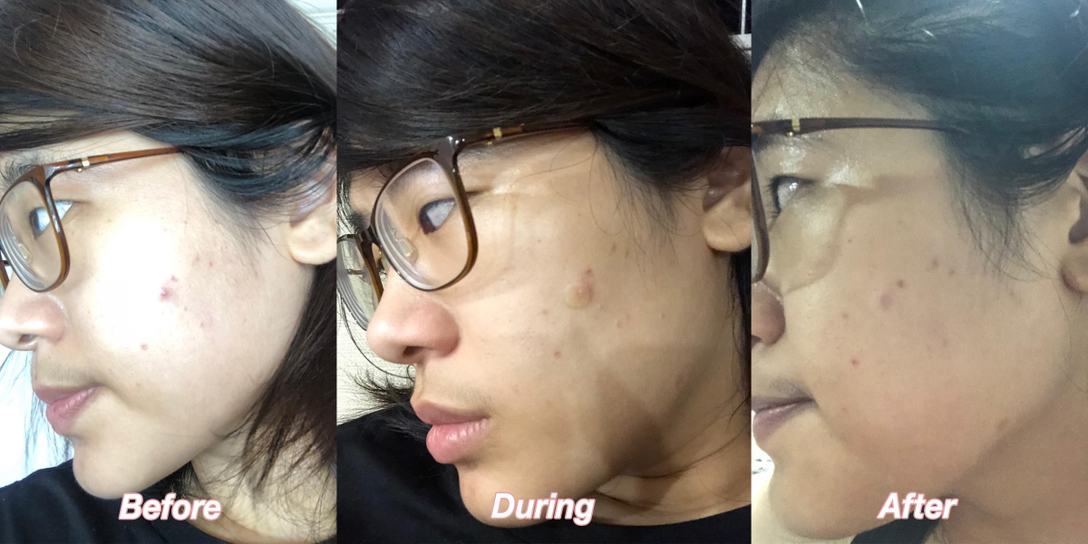 Sherry's before and after using Nexcare Tea Tree Acne Patch
