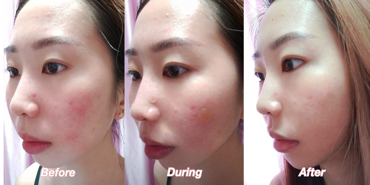 Clara before and after using Nexcare Tea Tree Acne Patch