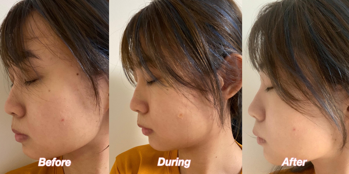 Cherie before and after using Nexcare Tea Tree Acne Patch