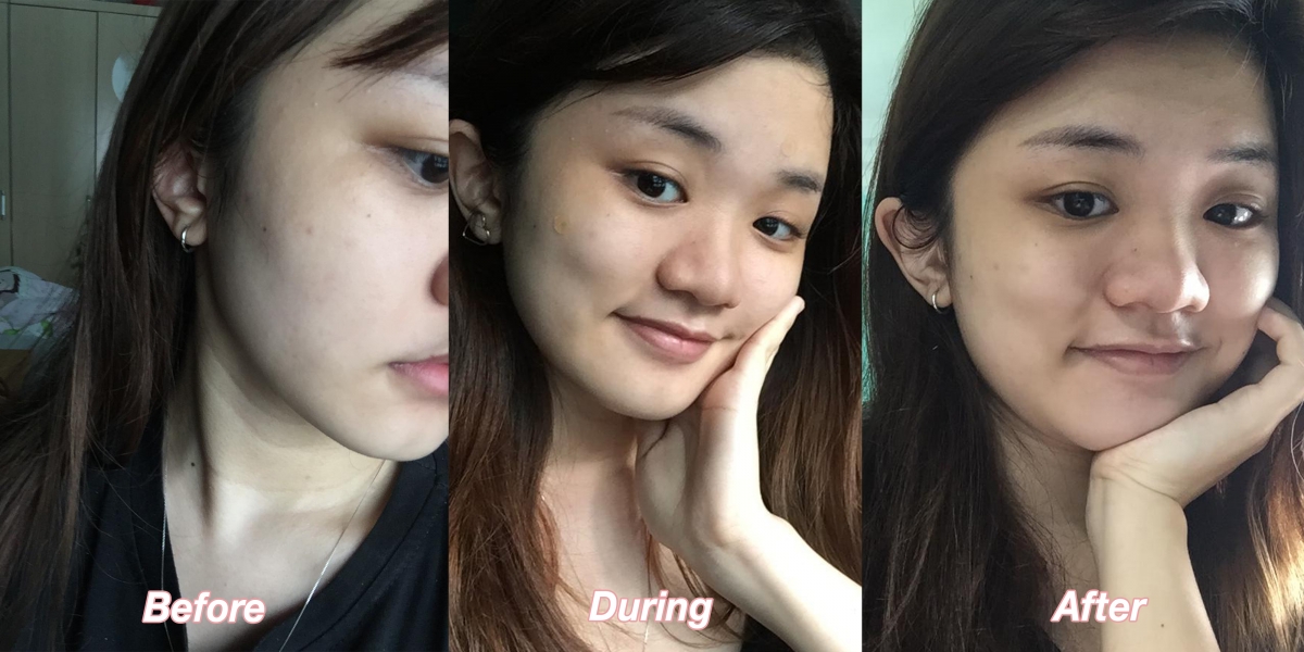 Janicia before and after using Nexcare Tea Tree Acne Patch