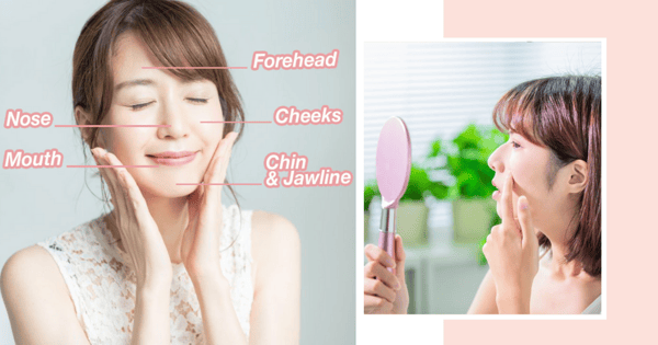 What's Triggering The Acne On Each Part Of Your Face & How To Prevent It