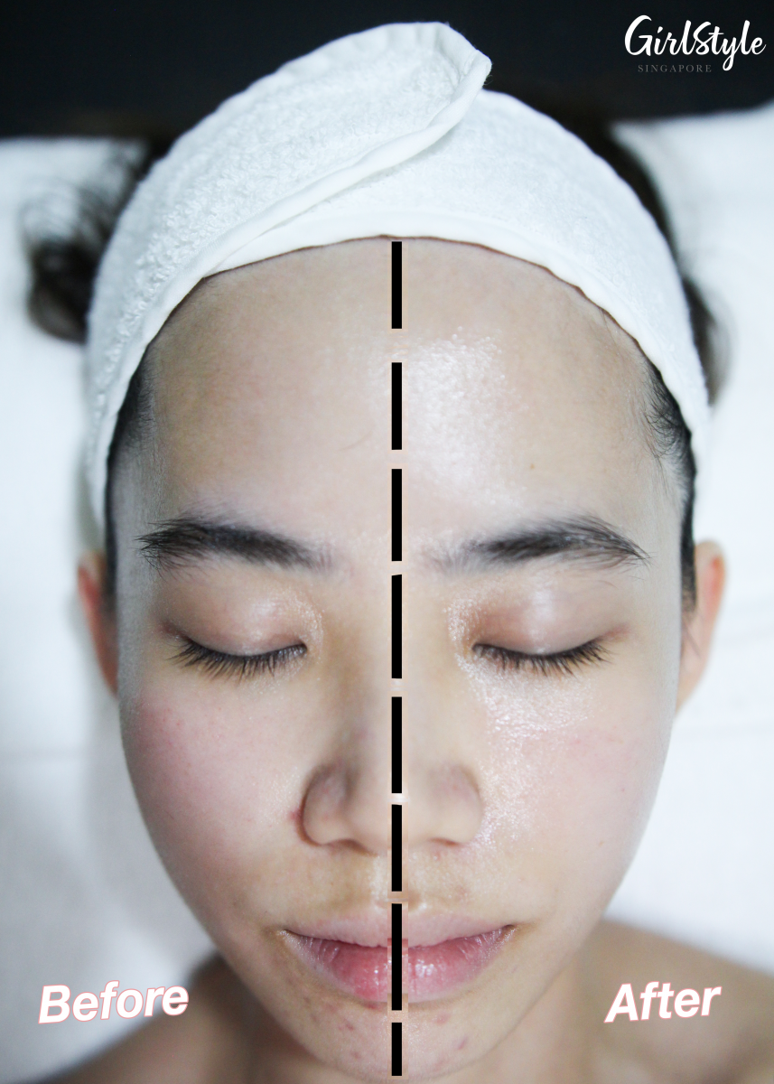 before after amber belia youth restorative facial singapore slimming