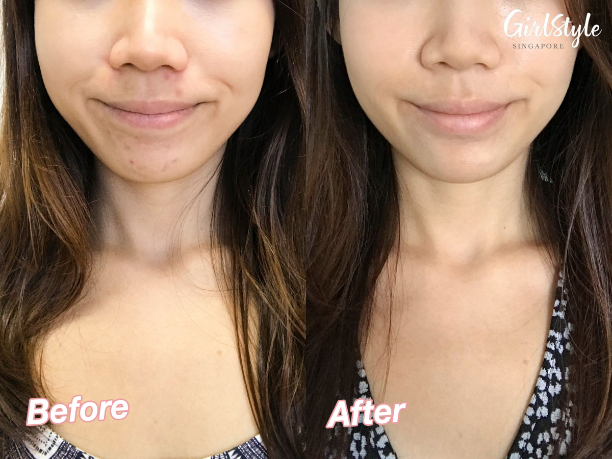 before after lumipeau skincare products