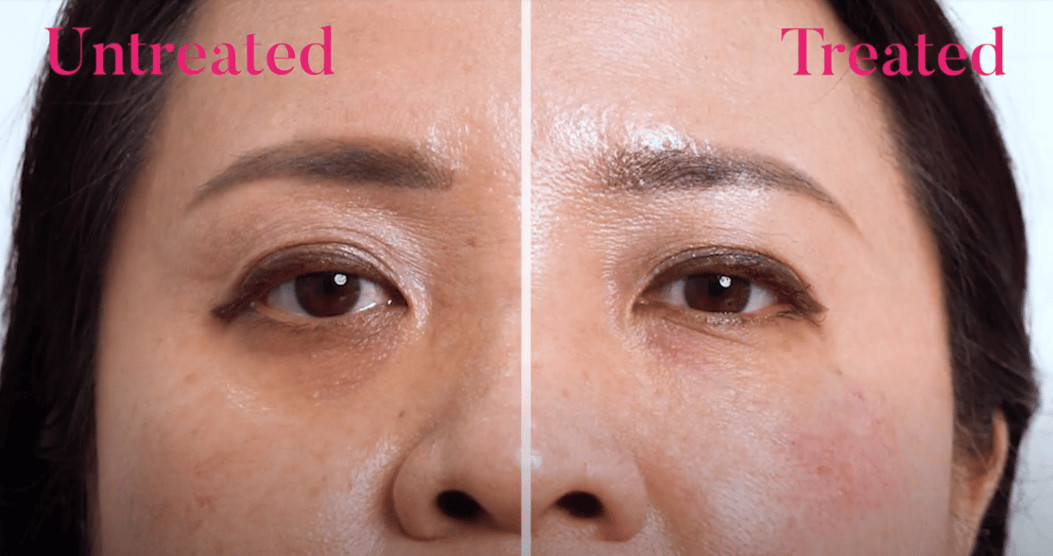 Kowayo Aesthetic Review Signature Dark Eye Circle & Eye Bag Removal