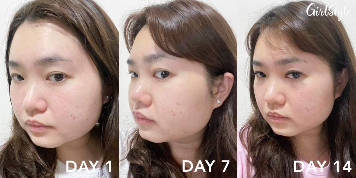 woman with acne-prone skin before and after trying bioderma Sebium Sensitive moisturiser in singapore