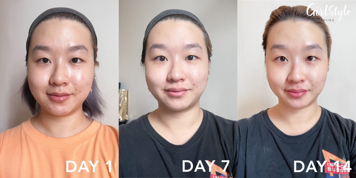 woman with acne-prone skin before and after trying bioderma Sebium Sensitive moisturiser in singapore