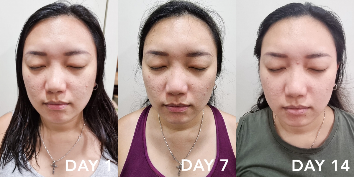 woman with acne prone skin before after using bioderma Sebium Sensitive moisturiser in singapore