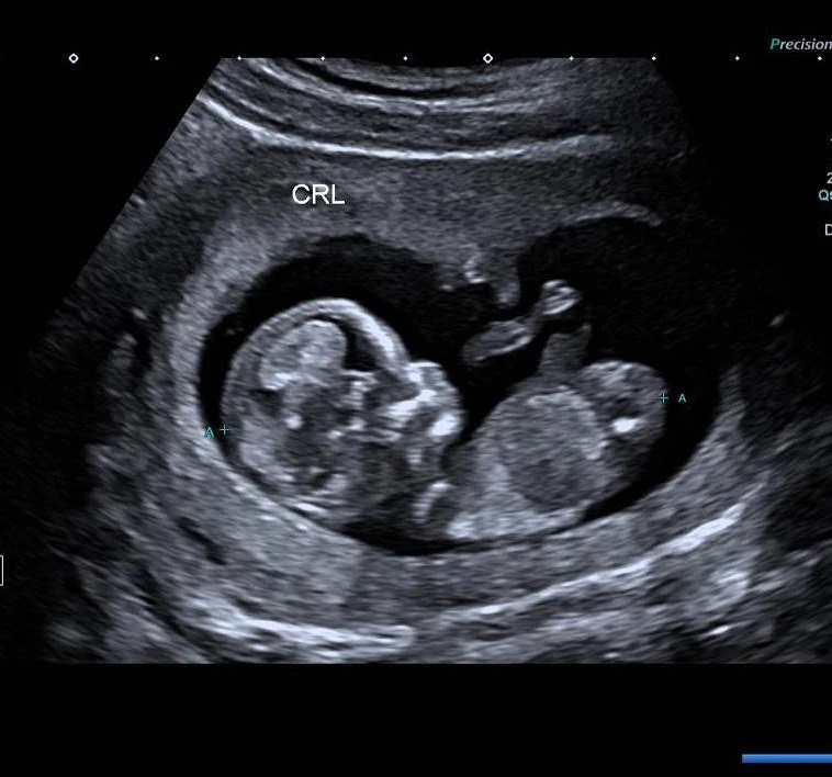 Joshua Ang new girlfriend baby