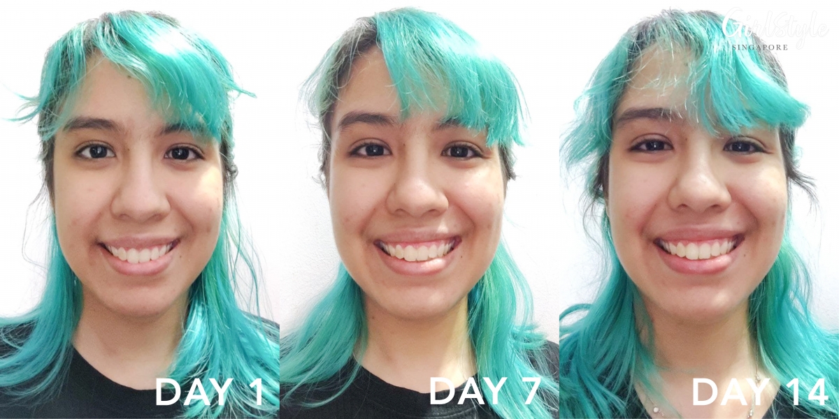 woman with acne-prone skin before and after trying bioderma Sebium Sensitive moisturiser in singapore
