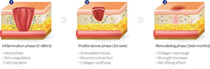 HIFU treatment Singapore Kowayo review_side effects
