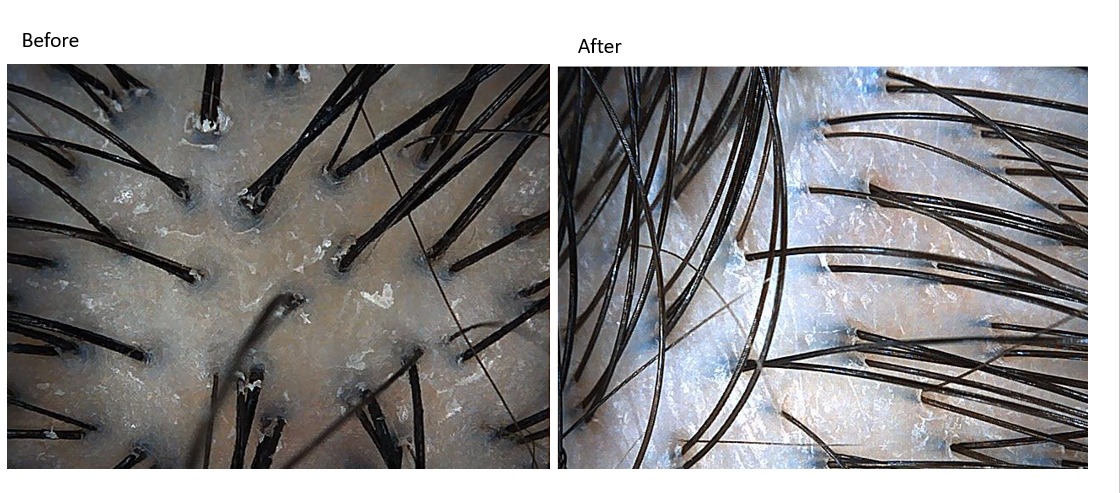 Yun Nam Hair Care_Before and after scalp scan