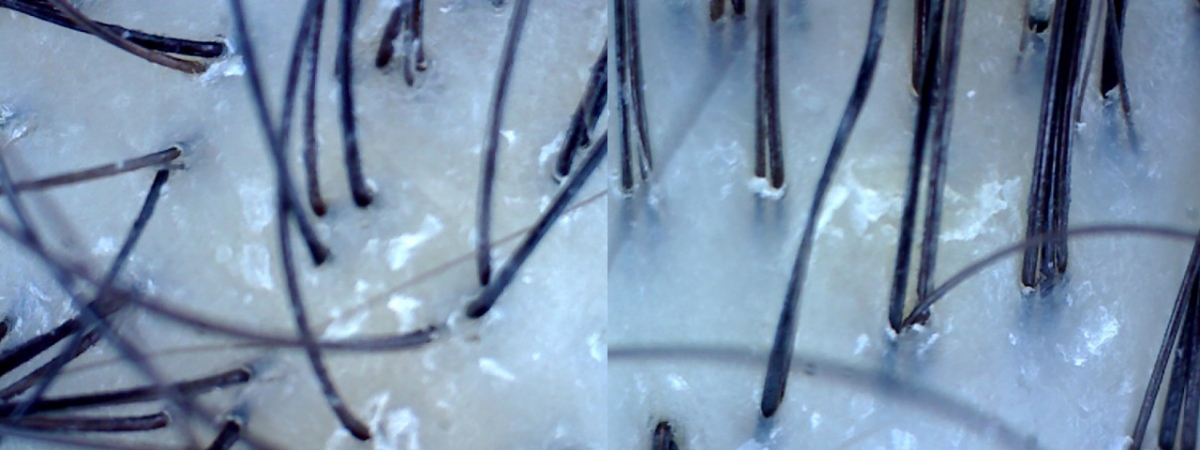 A scan of my scalp before the TK TrichoKare Advanced Scalp Detox & Care Treatment 