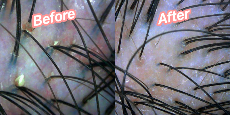The scan after the treatment showed that Karmen’s scalp is visibly less congested and red.