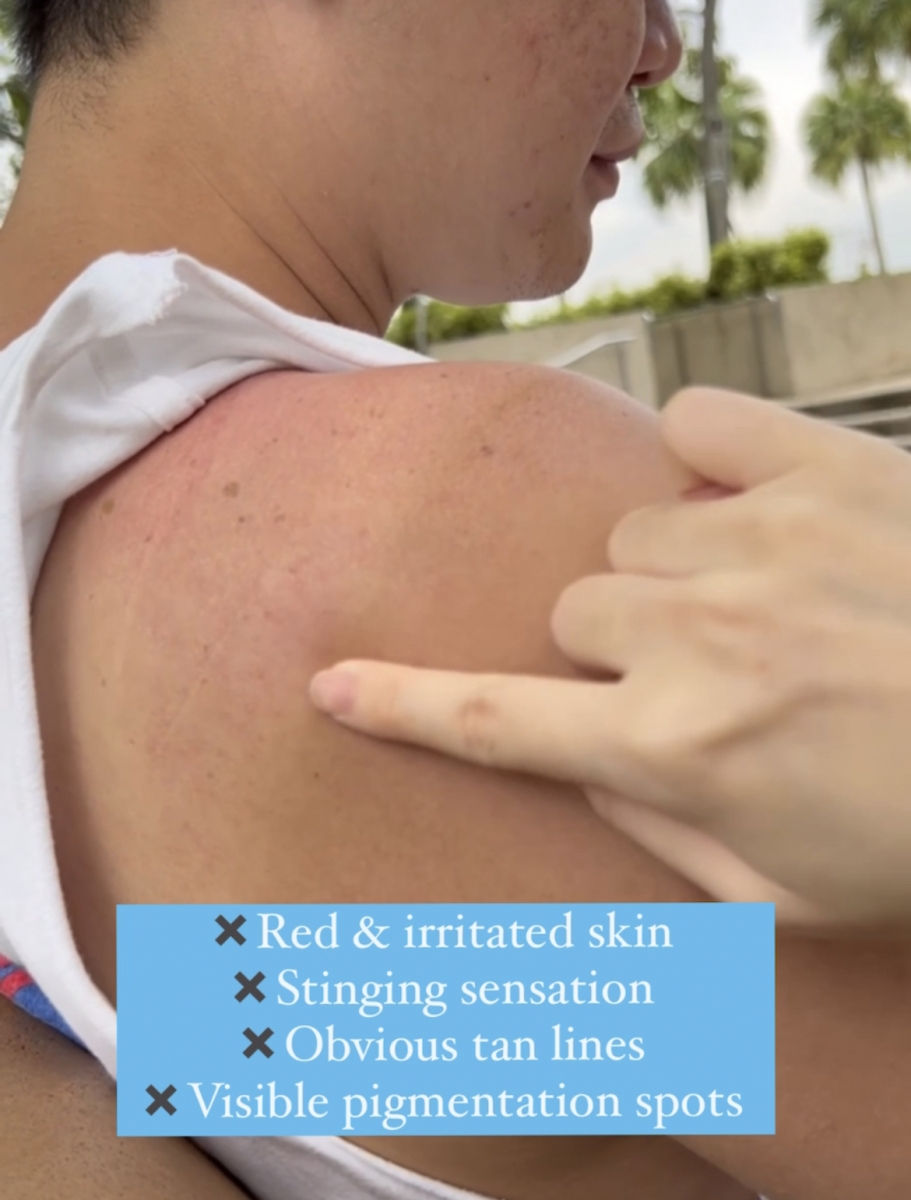 His skin after a day out in the sun without UV protection.