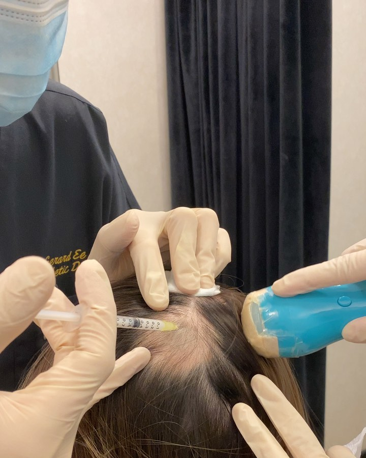 Nina Tan alopecia treatment