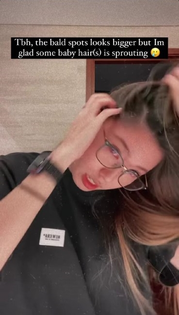 Nina Tan hair loss balding