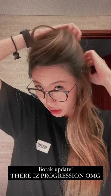 Nina Tan hair loss balding