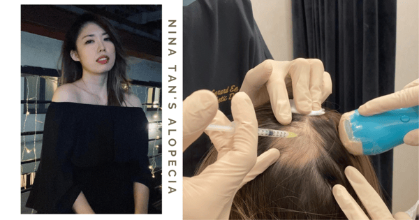 Nina Tan Shares Alopecia Update, Her Treatment Involves Injections, Meds, Swelling & Other Difficulties