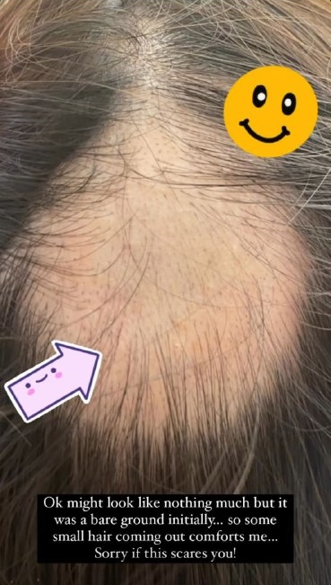 Nina Tan hair loss balding