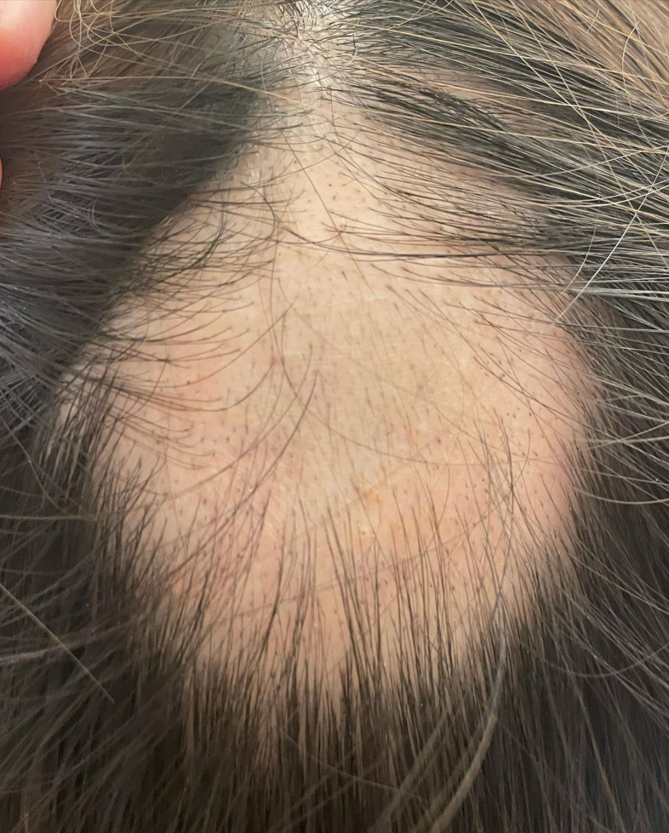 Nina Tan alopecia treatment