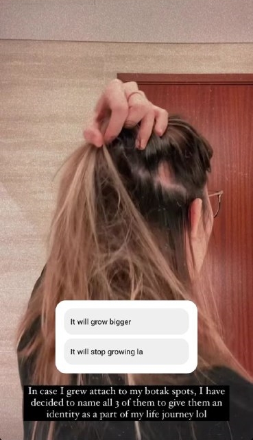 Nina Tan hair loss balding