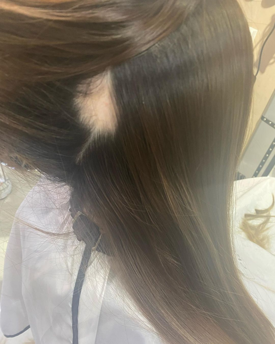 Nina Tan hair loss balding