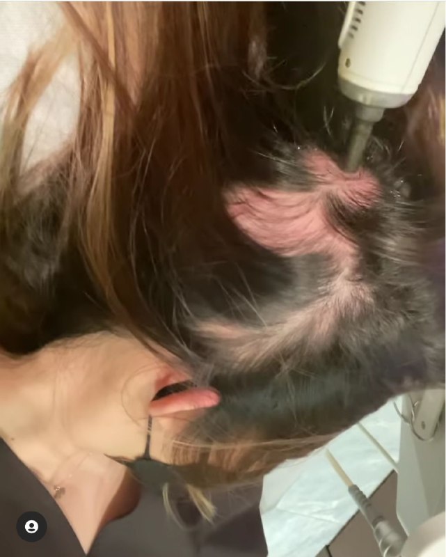 Nina Tan alopecia treatment