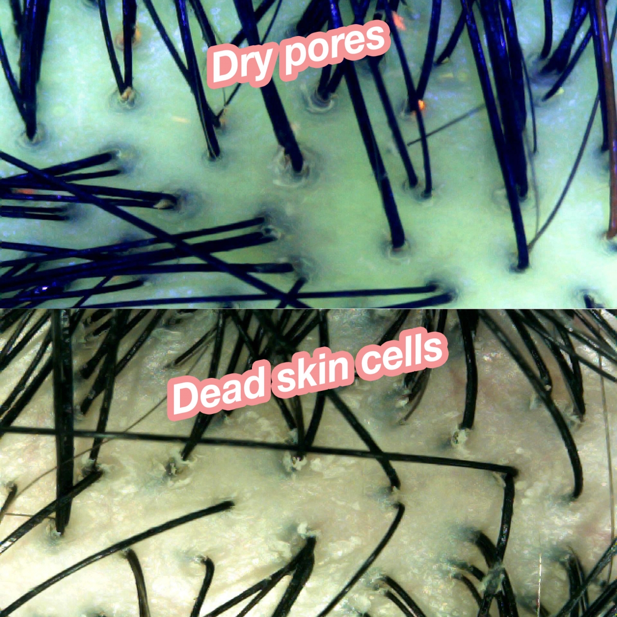The underlying cause of my dandruff - dry pores and dead skin cells. 