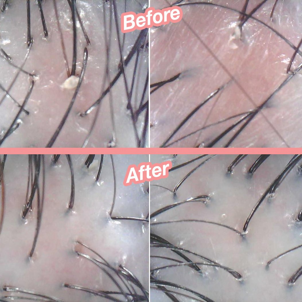 I Did A Scalp Exfoliation Treatment For 2 Weeks & Here’s How It