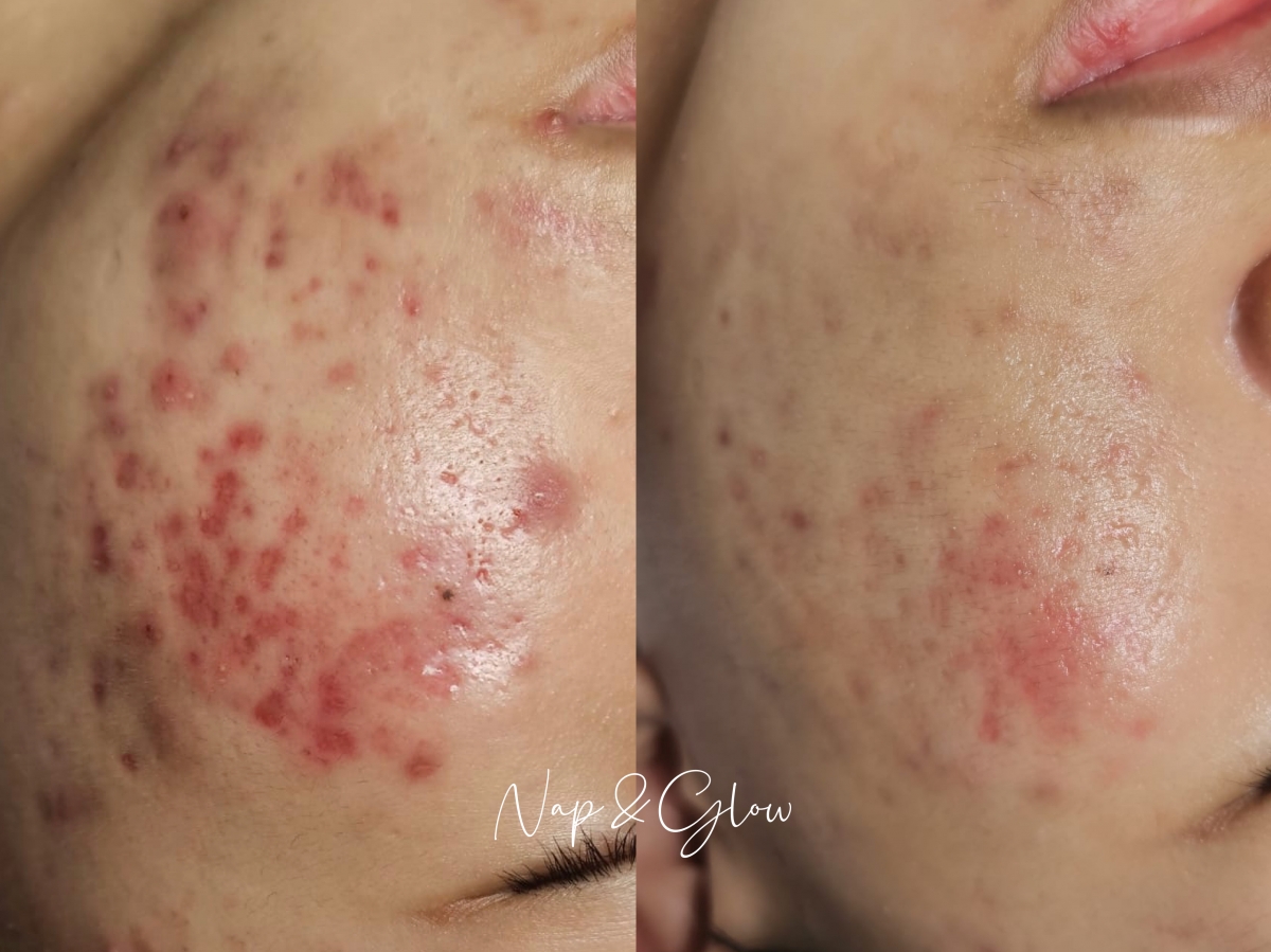 Nap & Glow SOS Treatment: Before and after.