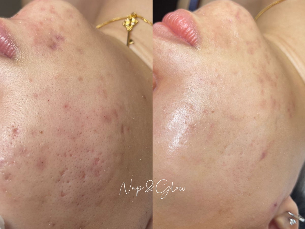 Nap & Glow SOS Treatment: Before and after.