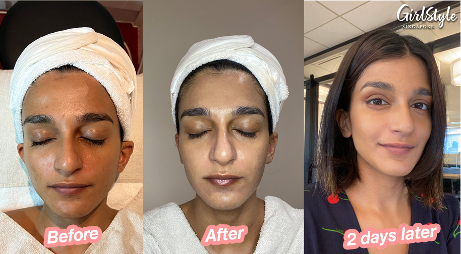 Besides having a glowy, glass-like skin, my cheekbones are now more pronounced and my jawline is more defined.