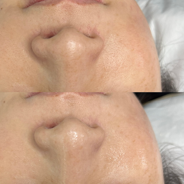 Holy Grail treatment