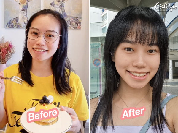 After one session of Multi-Modal Acne Eliminating Care Therapy, Xiaojie’s skin looked more radiant and her acne scars less visible. 
