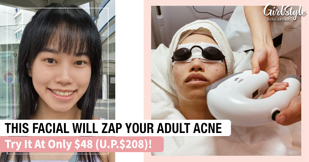 Embarrassed By Your Adult Acne? Good News! This Facial Will Zap Those Zits